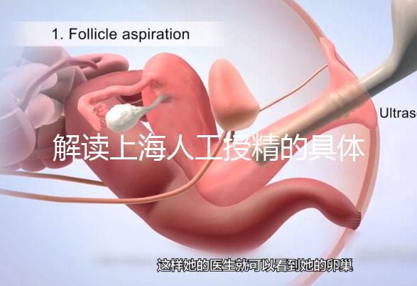 解讀上海人工授精的具體過程，會不會痛看醫(yī)生怎么說？