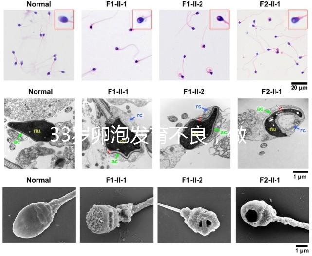 33歲卵泡發(fā)育不良，做試管黃體期促排方案失敗怎么辦？